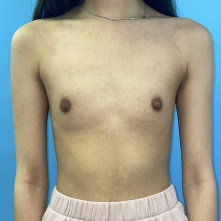 Before image 1 Case #123396 - The breasts I've always wanted...