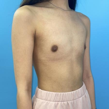 Before image 4 Case #123396 - The breasts I've always wanted...