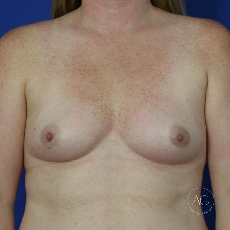 Before image 1 Case #123541 - Breast Augmentation