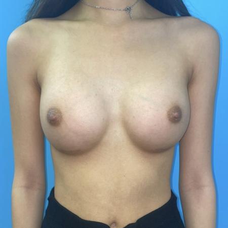 After image 1 Case #123396 - The breasts I've always wanted...