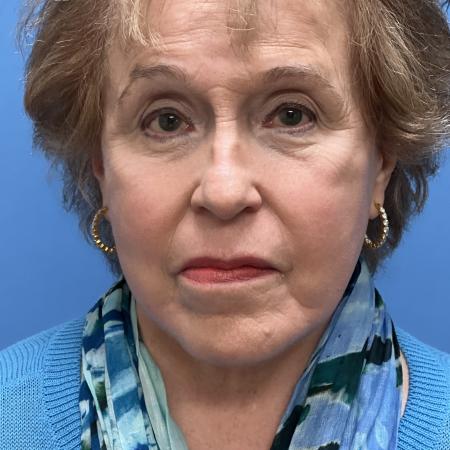 After image 1 Case #123526 - 74 year old Facelft