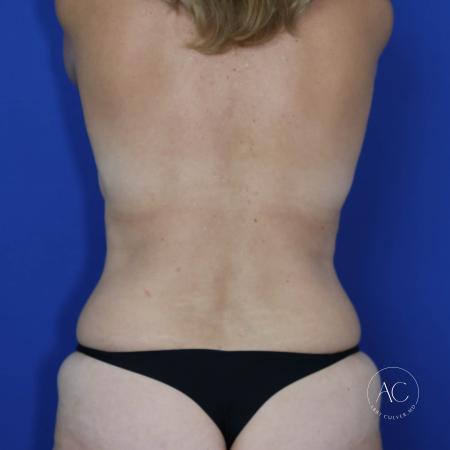 Before image 5 Case #123536 - Implant exchange, liposuction, abdominoplasty