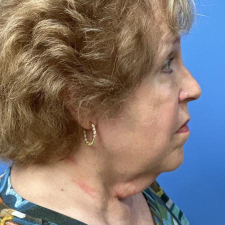 Before image 3 Case #123526 - 74 year old Facelft