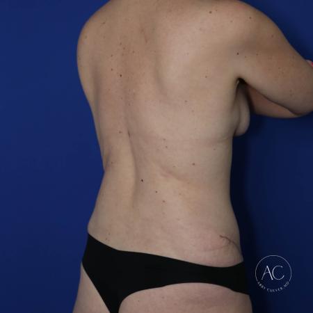 After image 4 Case #123546 - Breast augmentation, trunk lipo, abdominoplasty
