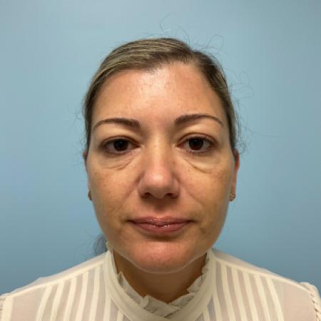 Before image 1 Case #123376 - 44 year old female with Botox injections & Filler