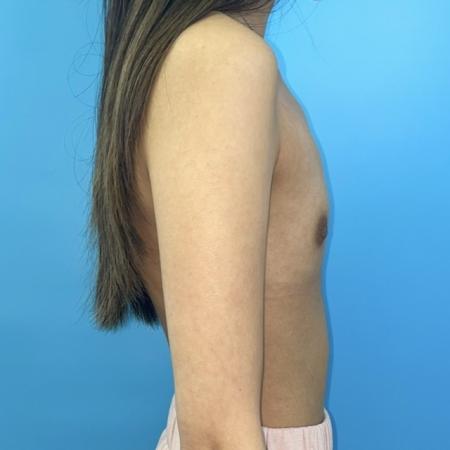 Before image 5 Case #123396 - The breasts I've always wanted...