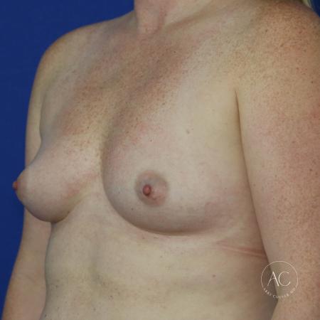 Before image 2 Case #123541 - Breast Augmentation
