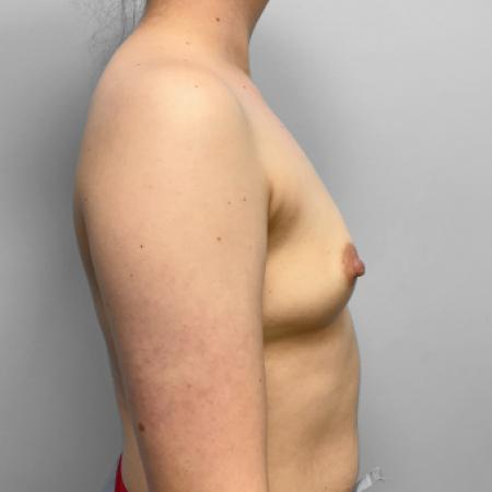 Before image 3 Case #123481 - Breast Augmentation