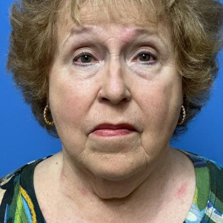 Before image 1 Case #123526 - 74 year old Facelft