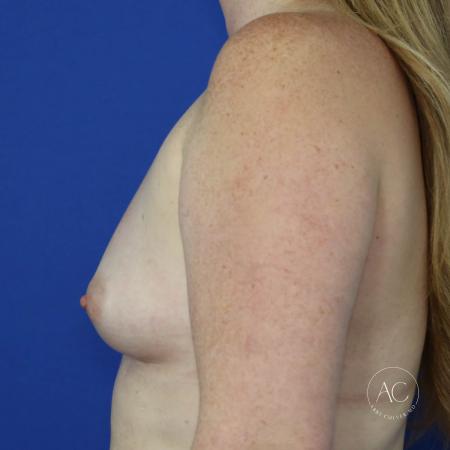 Before image 3 Case #123541 - Breast Augmentation