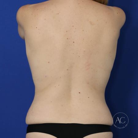 Before image 5 Case #123546 - Breast augmentation, trunk lipo, abdominoplasty