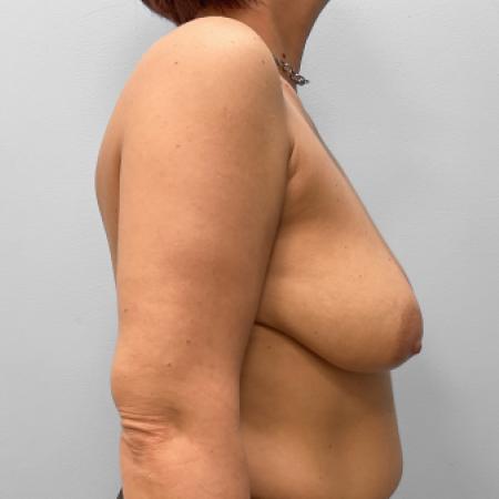 Before image 3 Case #123496 - Breast Augmentation & Lift