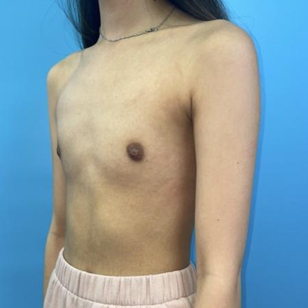 Before image 2 Case #123396 - The breasts I've always wanted...