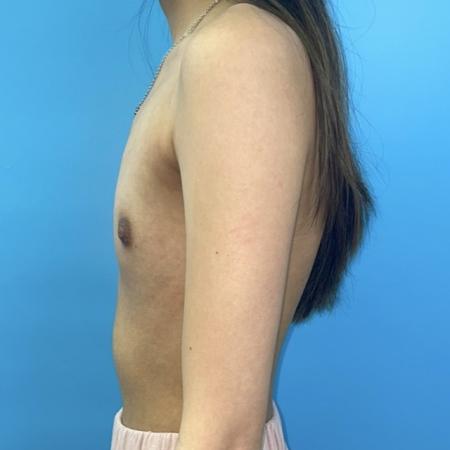 Before image 3 Case #123396 - The breasts I've always wanted...