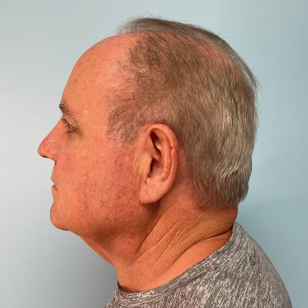 Before image 2 Case #124246 - 72 year old male with face/neck lift