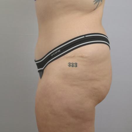 After image 2 Case #124541 - Tummy tuck Patient #1578