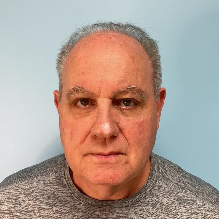Before image 1 Case #124246 - 72 year old male with face/neck lift