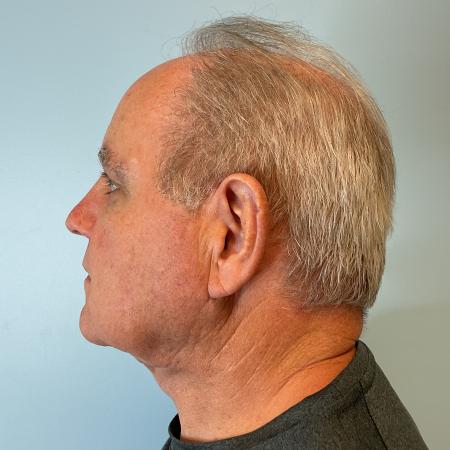 After image 2 Case #124246 - 72 year old male with face/neck lift