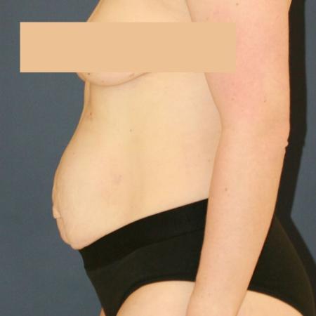 Before image 3 Case #124866 - Abdominplasty