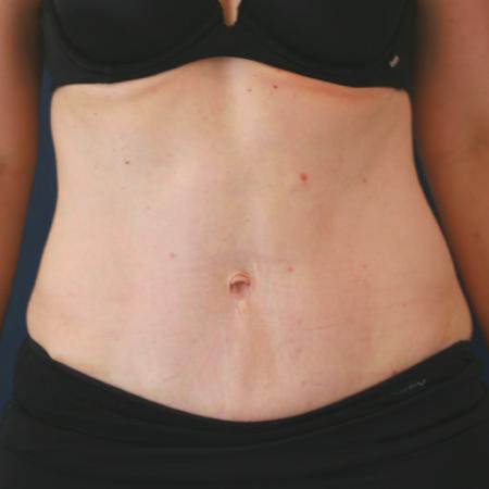 After image 1 Case #124866 - Abdominplasty