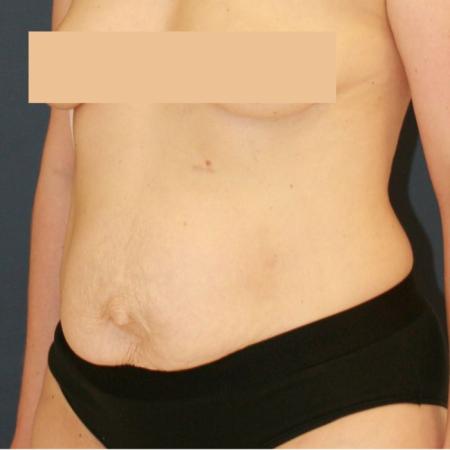 Before image 2 Case #124866 - Abdominplasty