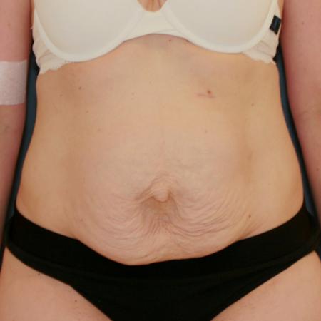 Before image 1 Case #124866 - Abdominplasty