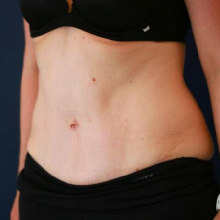 After image 2 Case #124866 - Abdominplasty