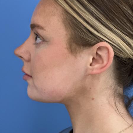After image 3 Case #125036 - LipoRF to the Neck