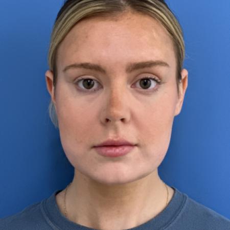 After image 1 Case #125036 - LipoRF to the Neck
