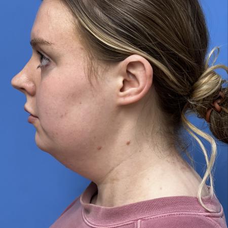Before image 3 Case #125036 - LipoRF to the Neck