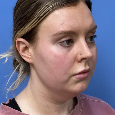 Before image 2 Case #125036 - LipoRF to the Neck