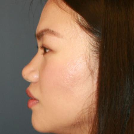Before image 3 Case #125676 - Open Rhinoplasty