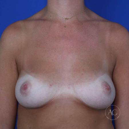Before image 1 Case #125806 - Inverted nipple repair
