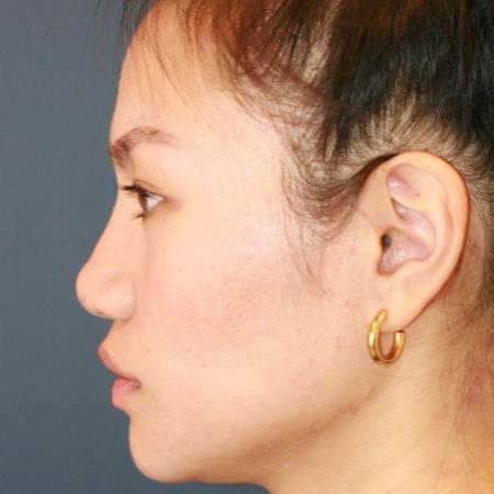 After image 3 Case #125676 - Open Rhinoplasty
