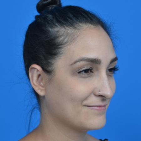 After image 2 Case #126236 - otoplasty 27 year old woman