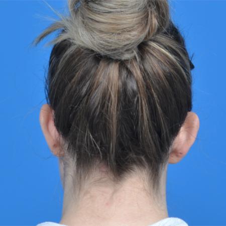 Before image 4 Case #126576 - otoplasty 31 year old woman