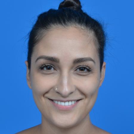 After image 1 Case #126236 - otoplasty 27 year old woman