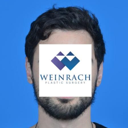 After image 1 Case #126571 - Otoplasty 32 year old