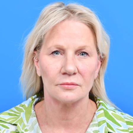 Before image 1 Case #126561 - Lip lift