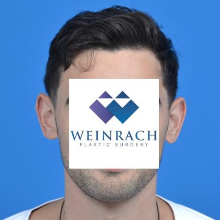 Before image 1 Case #126571 - Otoplasty 32 year old