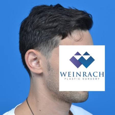 Before image 2 Case #126571 - Otoplasty 32 year old