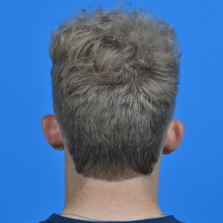 Before image 4 Case #126566 - Otoplasty 19 year old