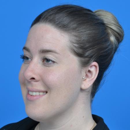 After image 2 Case #126576 - otoplasty 31 year old woman