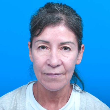 Before image 1 Case #126556 - Lip Lift