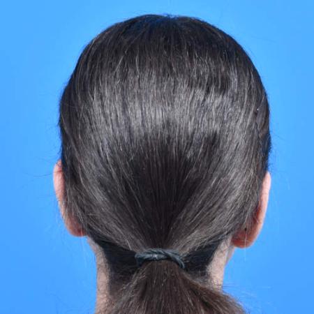 After image 4 Case #126221 - Otoplasty 11 year old