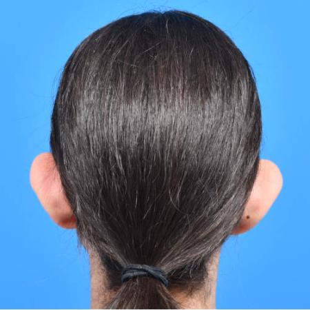 Before image 4 Case #126221 - Otoplasty 11 year old