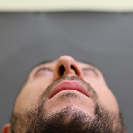 Before image 3 Case #126831 - Rhinoplasty