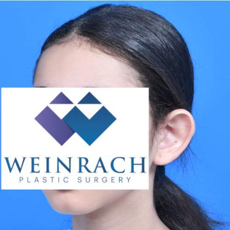 Before image 2 Case #126221 - Otoplasty 11 year old