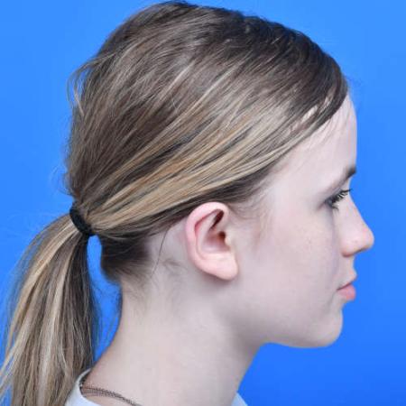 After image 3 Case #126226 - Otoplasty 14 year old