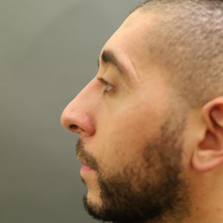 Before image 2 Case #126831 - Rhinoplasty